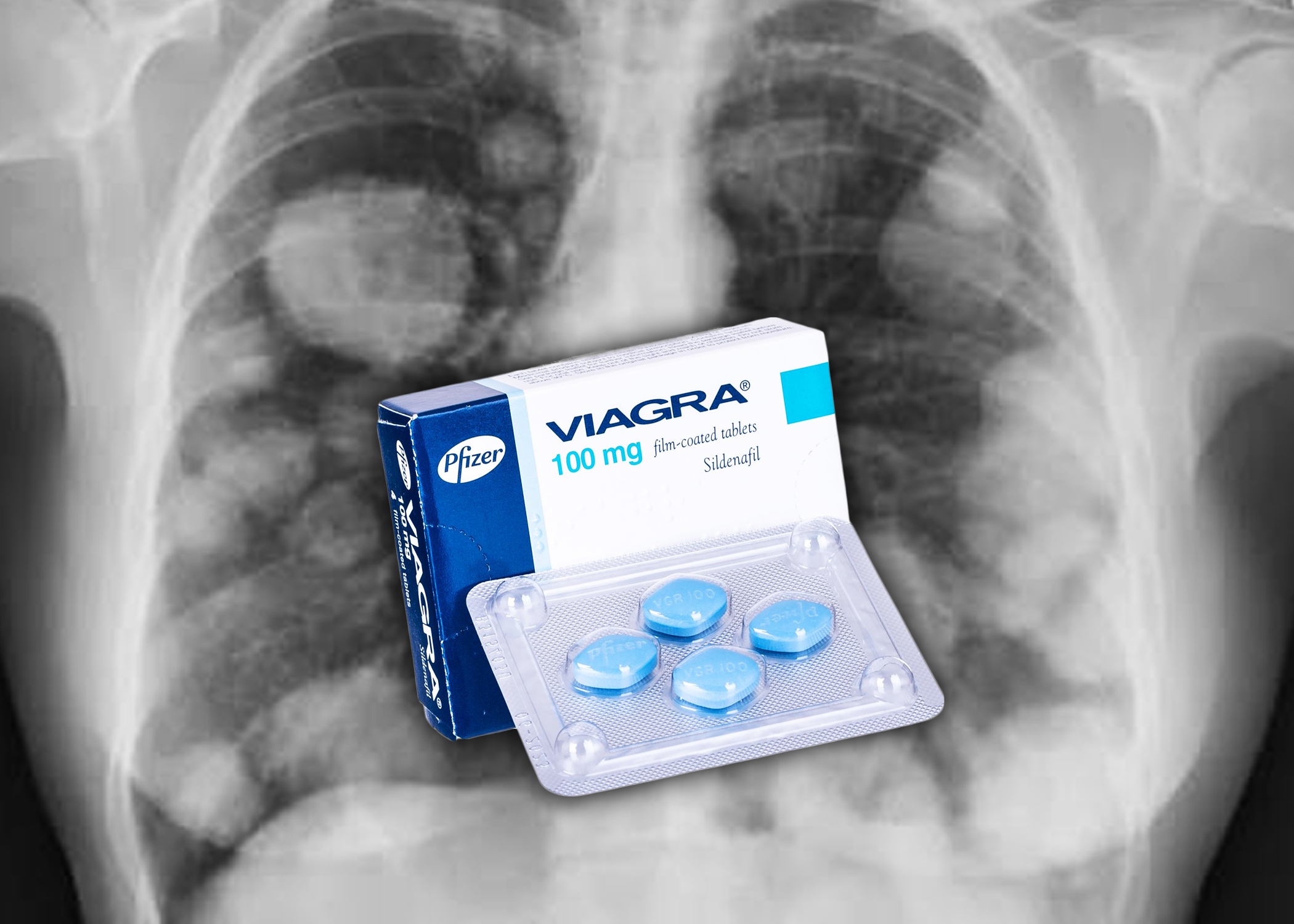 La VIAGRA, el tratamiento de la  disfunción eréctil podría servir  para frenar el cáncer según  nuevo hallazgo científico